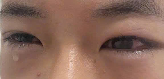 Cẩn trọng khi dùng hạt na để trị chấy – Mẹo dân gian tiềm ẩn nguy cơ gây bỏng mắt.